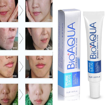 Bioaqua Crema Removedora De Acne